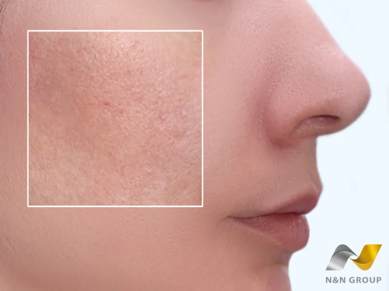 Plasma lạnh se khít lỗ chân lông – Giải pháp phục hồi tự nhiên