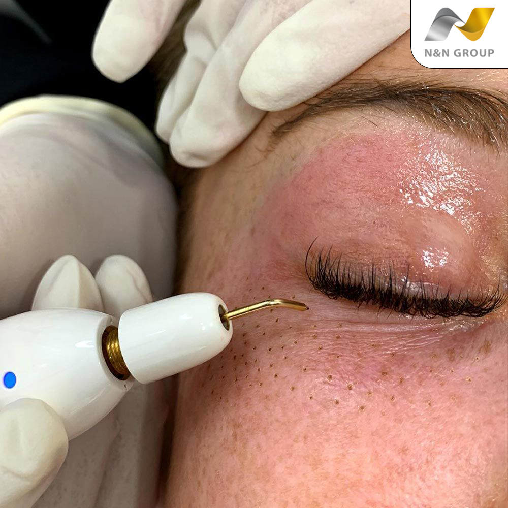 Đối tượng phù hợp với trẻ hóa bằng nguyên bào sợi