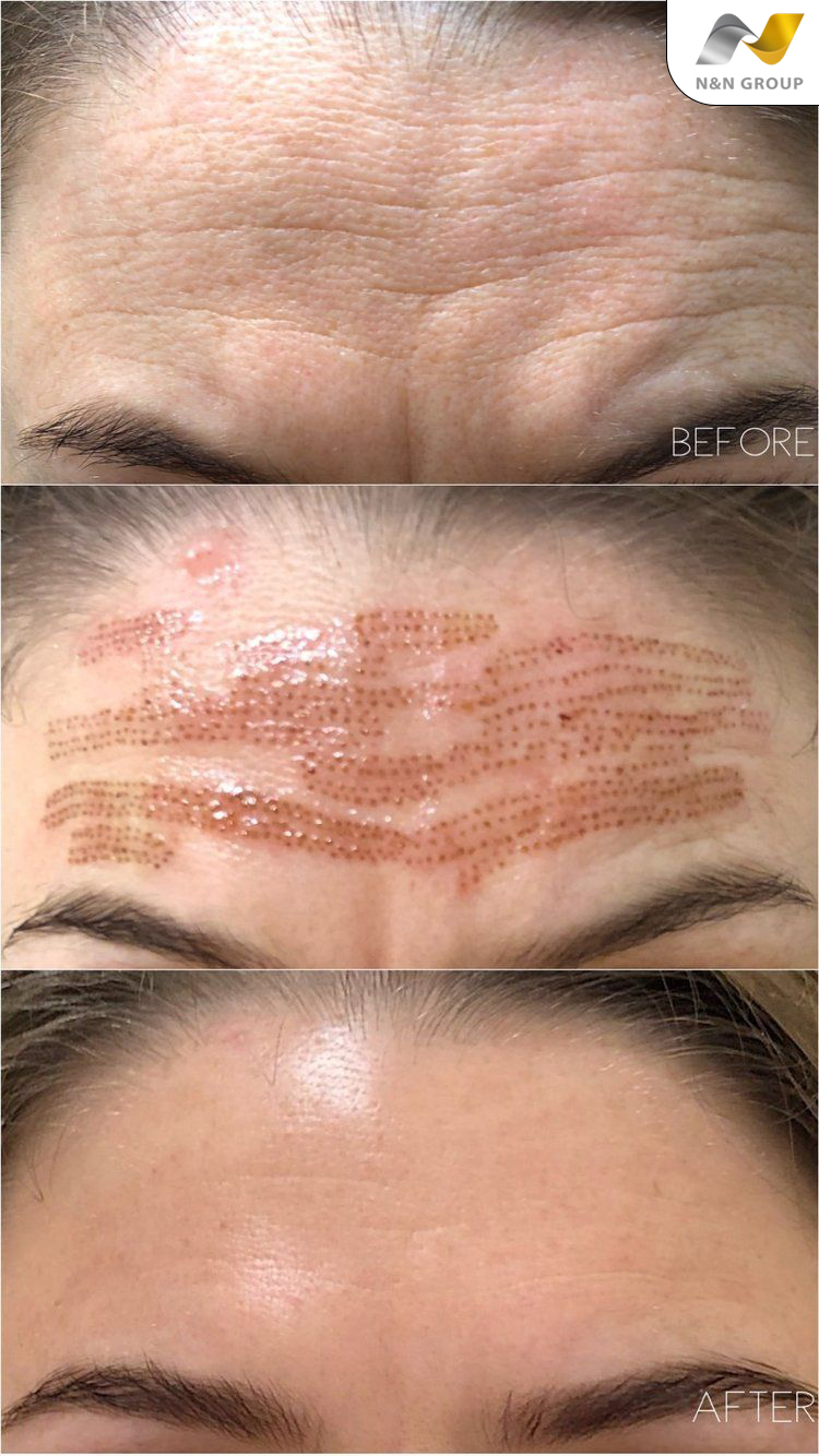 Trẻ hóa da bằng nguyên bào sợi